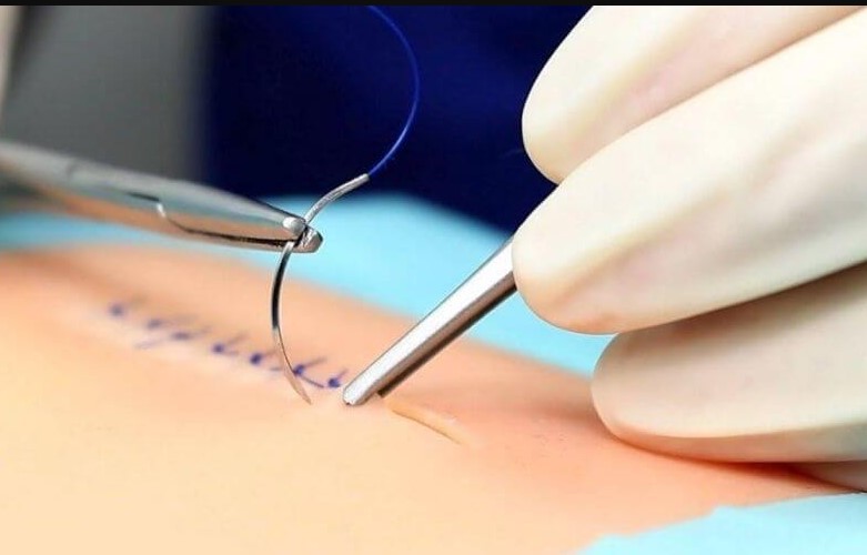 Trong quá trình cắt chỉ, đôi khi vết thương còn sưng nên y bác sĩ cắt chỉ còn sót chỉ.