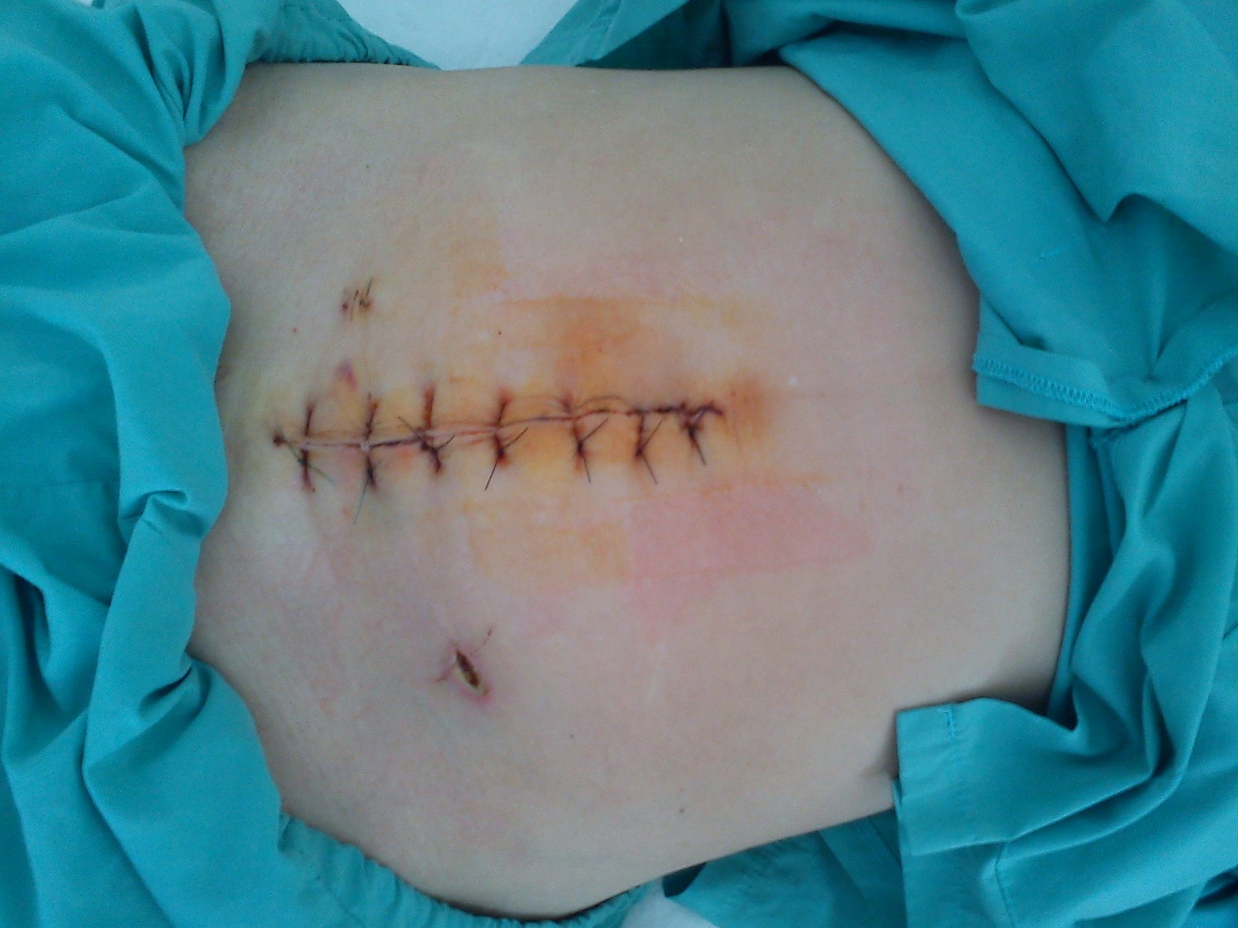 Vậy khi bị sót chỉ thì các bạn có nên tự lấy chỉ ra không? 