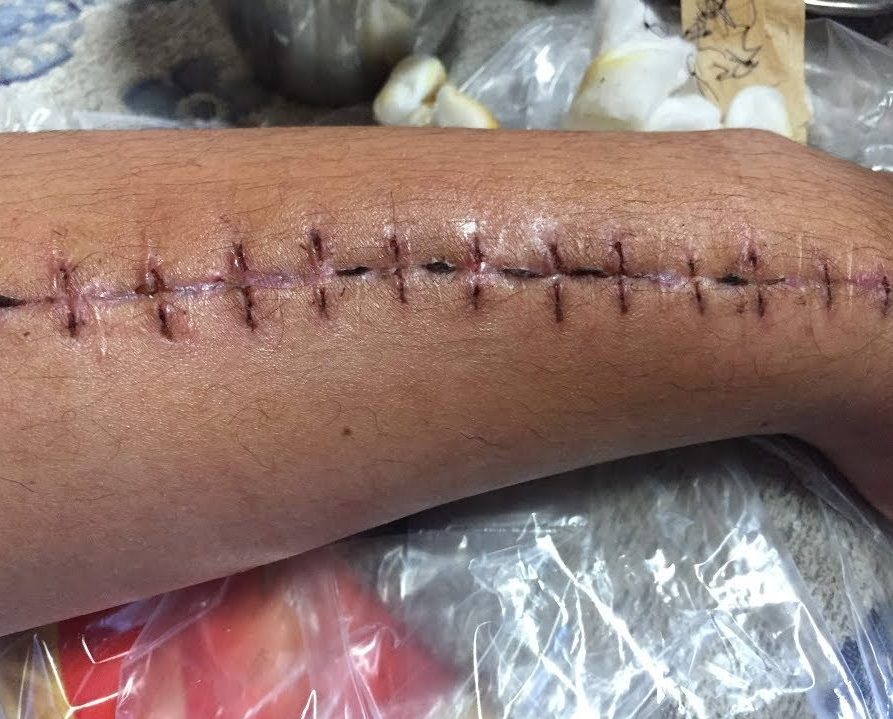 Nguyên tắc khi thực hiện cắt chỉ vết thương