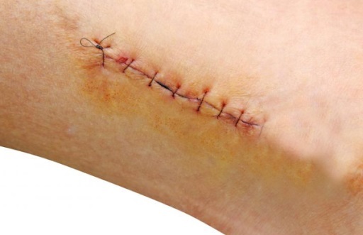 Nguyên tắc khi thực hiện thay băng cắt chỉ vết thương?