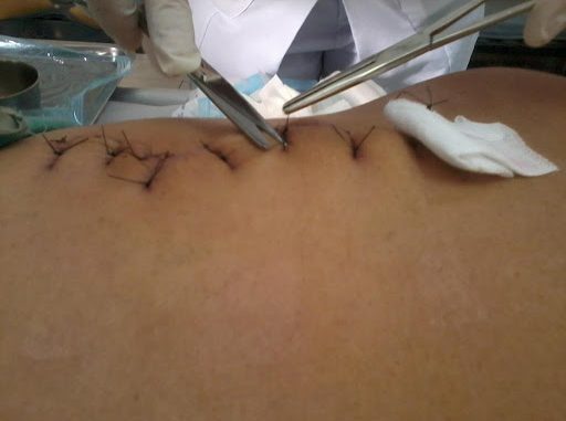 Vết thương mấy ngày thì cắt chỉ? Cắt chỉ vết thương có đau không?