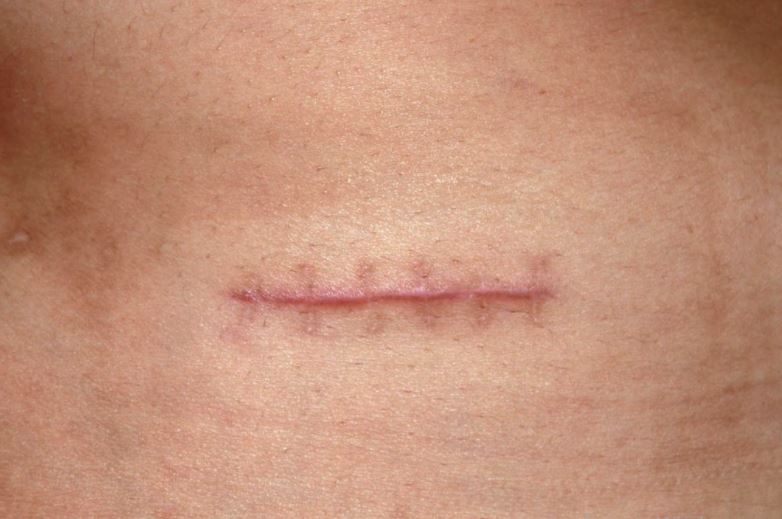 Đơn vị thay băng cắt chỉ vết thương tại nhà uy tín nhất