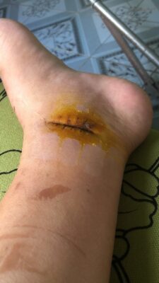 Trong quá trình thay băng, rửa vết thương, cần lưu ý