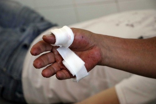 Thay băng vết thương tại nhà có thể tự thực hiện không?